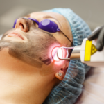 Laser skin resurfacing procedure